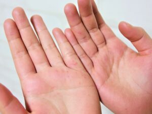 日本初!アラジール症候群・PFICの激しいかゆみに「リブマーリ」発売開始